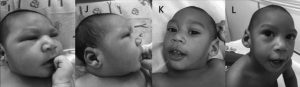 Clinical photographs of an infant with congenital Zika syndrome, who was born in Brazil with a normal-sized head. At 12 months, the infant had clear microcephaly. MUST CREDIT: CDC.